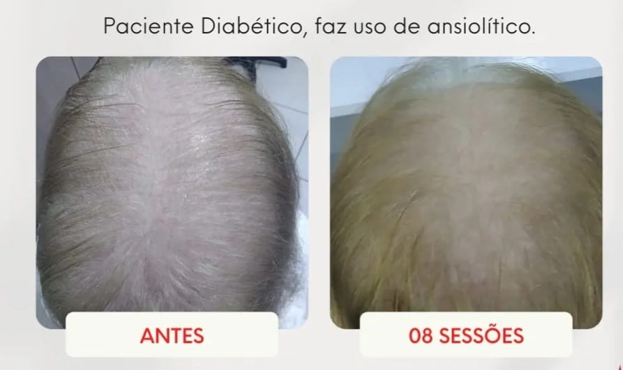 Queda com Comorbidades — 8 sessões