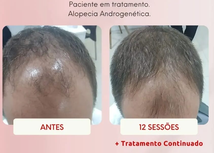 Alopecia Androgenética — 12 sessões