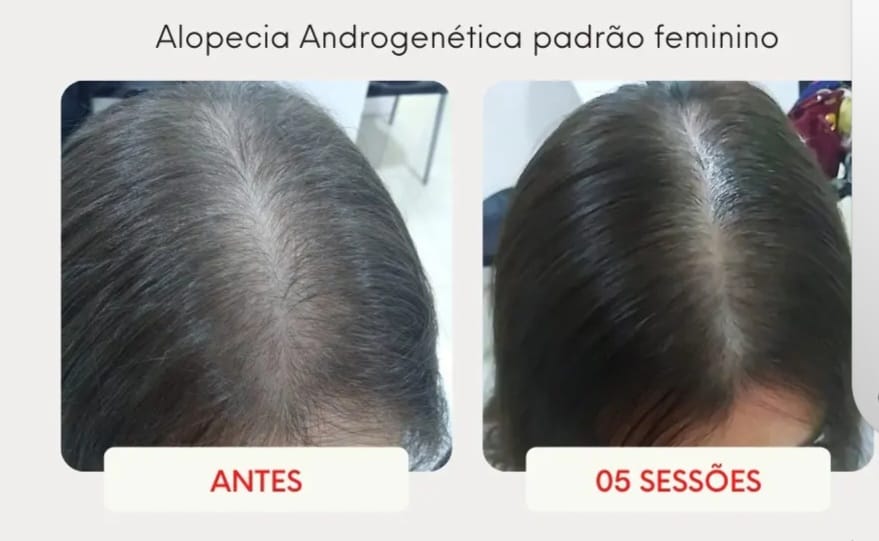 Alopecia Androgenética Feminina — 5 sessões