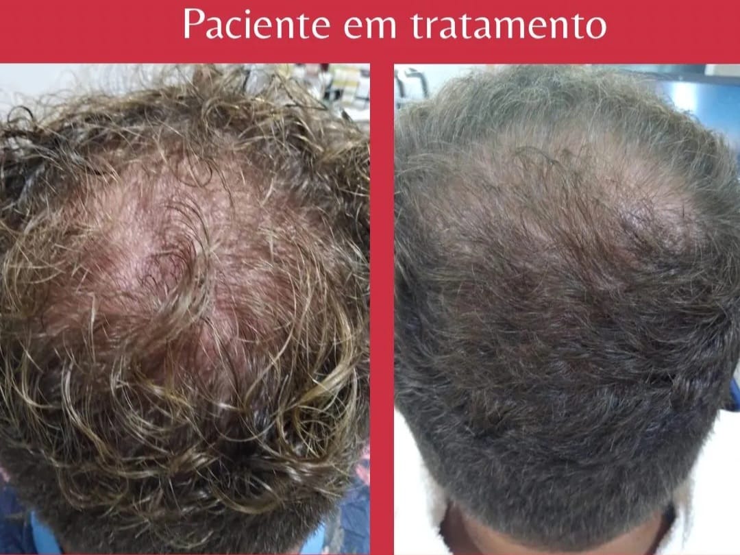 Queda Difusa — protocolo MCM